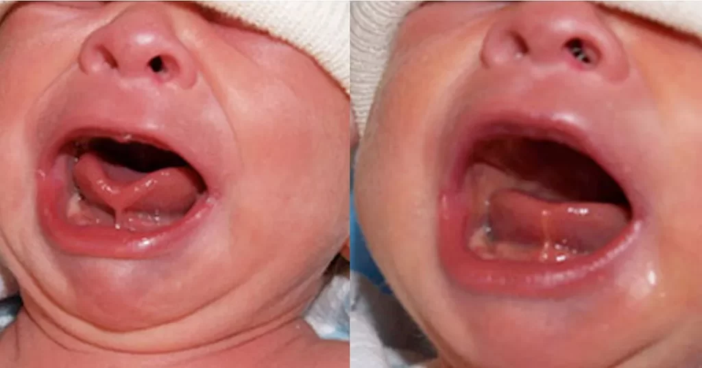 Antes e depois de cirurgia de lingua presa / Frenectomia / frenotomia. 