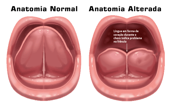Ilustração de frenulo alterado.
